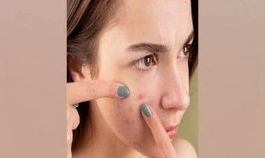 Treatment for acne scars: The types and their relevance explained