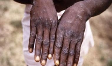 First monkeypox case reported in Delhi, man with no foreign travel history tests positive; India's tally rises to four