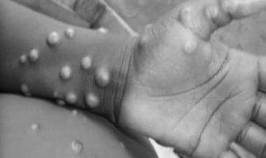 Monkeypox cases concentrated among men who have sex with men: WHO