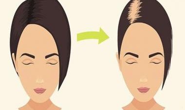 From Aloe Vera to Brahmi: Best home remedies to prevent hair fall