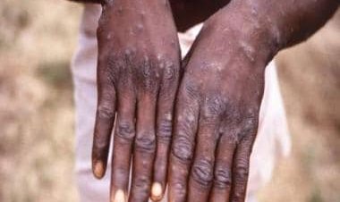 How the current monkeypox outbreak can become endemic