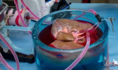 50 years ago, scientists hoped freezing donor organs would boost transplants