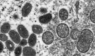 In a first, man tests positive for COVID-19, HIV, monkeypox at the same time