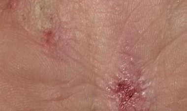 Severe and persistent Atopic Dermatitis and flare-ups: All you need to know