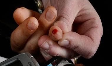 From blurry vision to extreme hunger: The lesser-known symptoms of diabetes