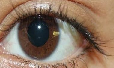 Five home remedies to get rid of bags under eyes