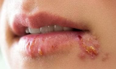 Herpes Infections: Types, causes, risks and treatment