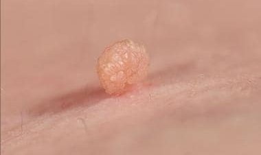 Five remedies to remove skin tags at home