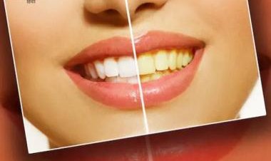 From baking soda to apple cider vinegar, 5 home remedies to whiten teeth