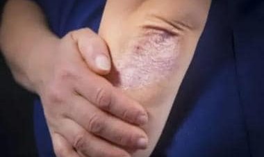 World Psoriasis Day 2022: Foods to eat and avoid