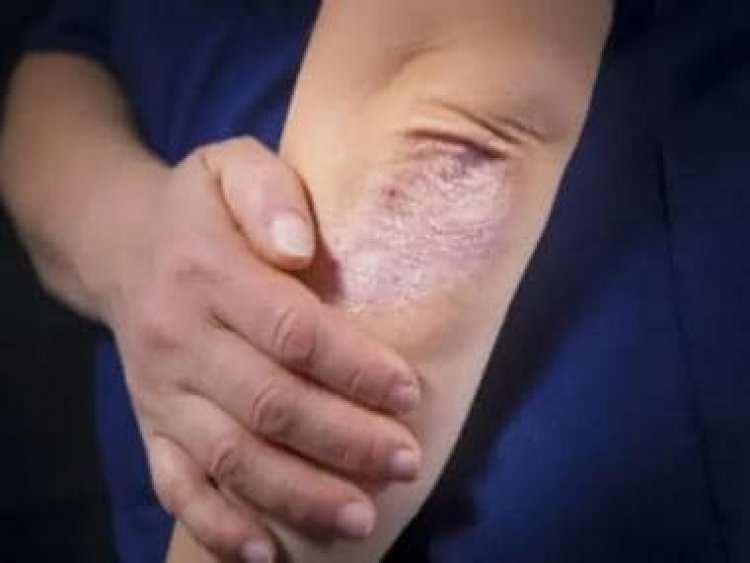 World Psoriasis Day 2022: Foods to eat and avoid