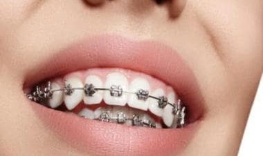 Dental aligners: Wide gap in knowledge and training needs to be corrected for acceptability