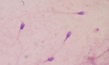 A bleak future for mankind: Why is there a significant decline in sperm count globally including India?