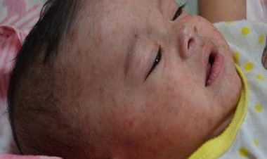 Should measles vaccine be given at six months instead of nine for infants?