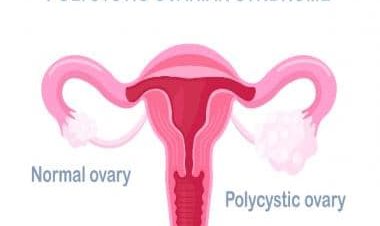 Lean PCOS may remain undiagnosed due to normal BMI levels