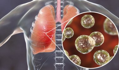 4 key things to know about lung infections caused by fungi