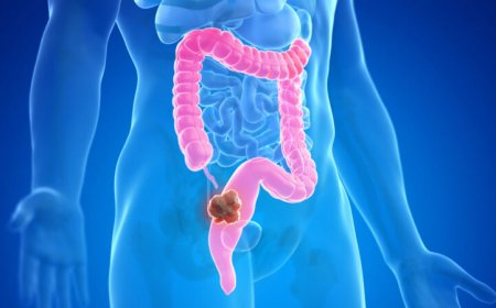 Why are more people under 50 getting colorectal cancer? Scientists have some clues