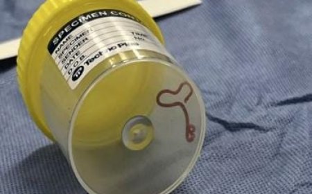 Oh My Worm: How Australian doctors found and removed a 3-inch live parasite from a woman’s brain