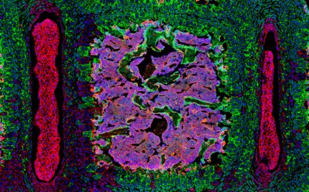 Newly identified stem cells can lure breast cancer to the spine