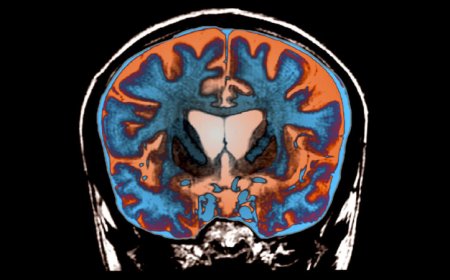 Why Huntington’s disease may take so long to develop