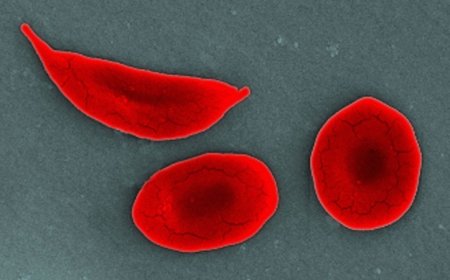 The first CRISPR therapy approved in the U.S. will treat sickle cell disease
