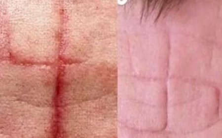 Russians accused of carving swastikas on captured Ukrainians