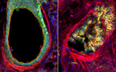 Chronic asthma could be caused by cell overcrowding in the airways