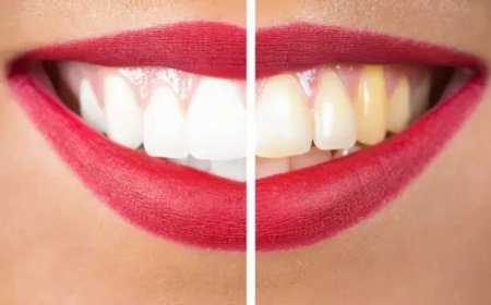 Oral Health: 5 Foods That Can Naturally Whiten Teeth And Brighten up Your Smile