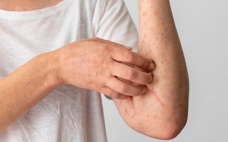 What is Scleroderma? Why is it More Common in Women Than Men? All You Need to Know