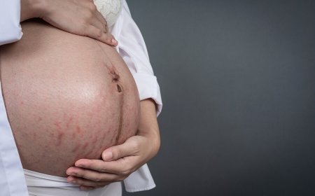 Stretch Marks to Acne, 5 Skin Problems Women Face During Pregnancy