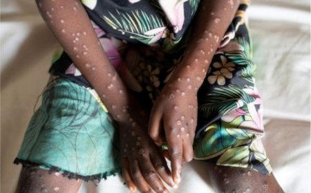 Pakistan Detects 1st Mpox Case Of 2024, Infected Person Came From Saudi Arabia; Screening At Airport Begins