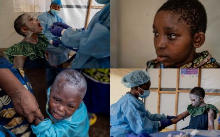 EXPLAINER: With WHO Declaring Mpox Global Health Emergency, Will It Trigger Another COVID Like Pandemic?