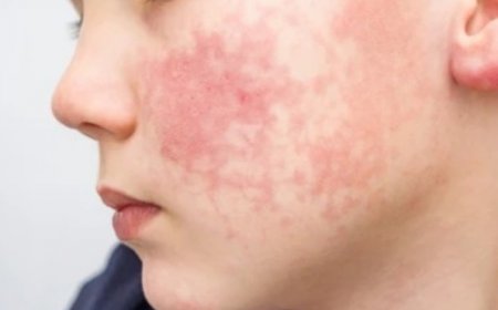 Parvovirus B19 Alert: What is ‘Slapped Cheek’ Disease? All You Need to Know About This Rising Respiratory Virus