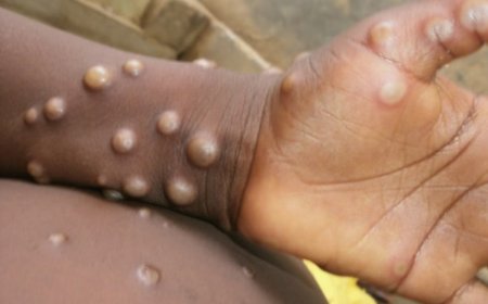 First Case Of Monkeypox Confirmed In India: Ministry Of Health