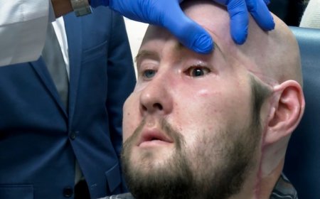 The first face transplant to include an eye shows no rejection a year later