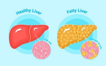 Can you reverse fatty liver? 5 things to know about this common disease