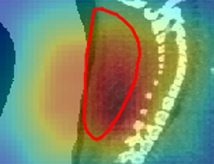 Radioactive beams give a real-time view of cancer treatment in mice